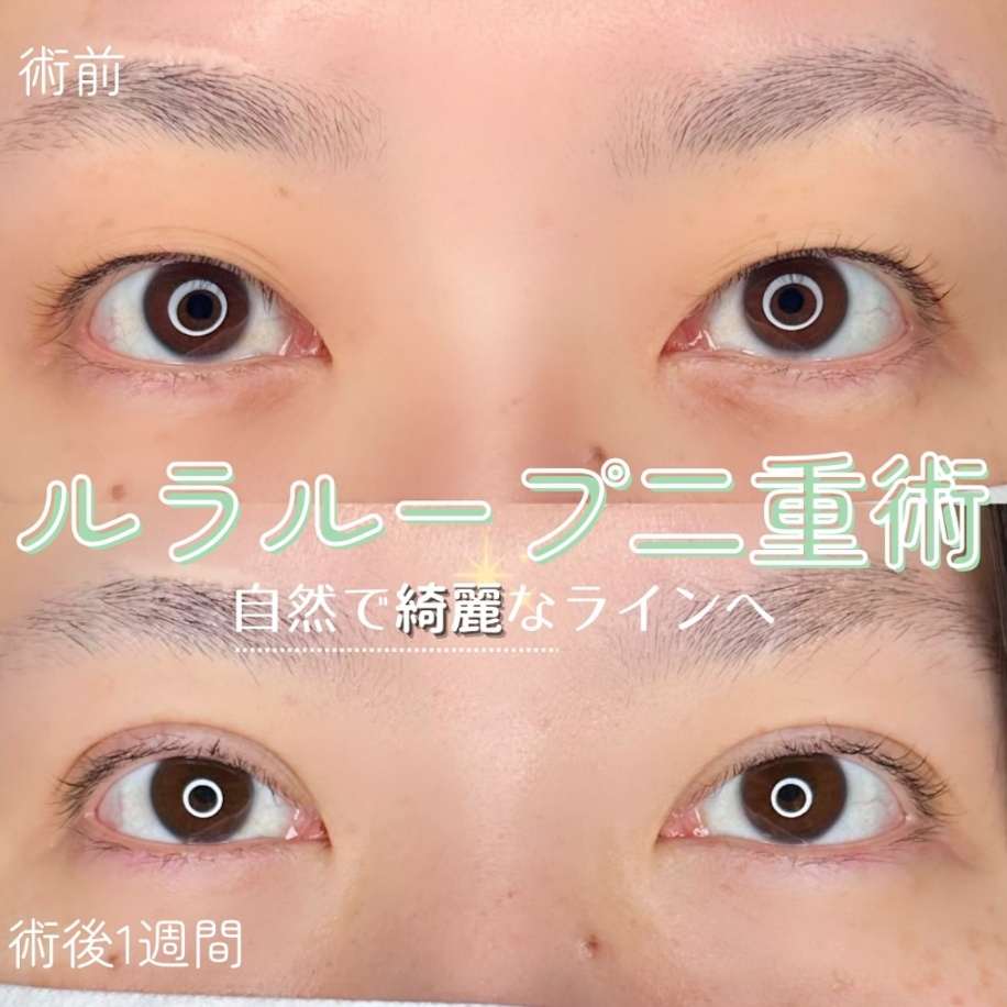 双眼皮手术