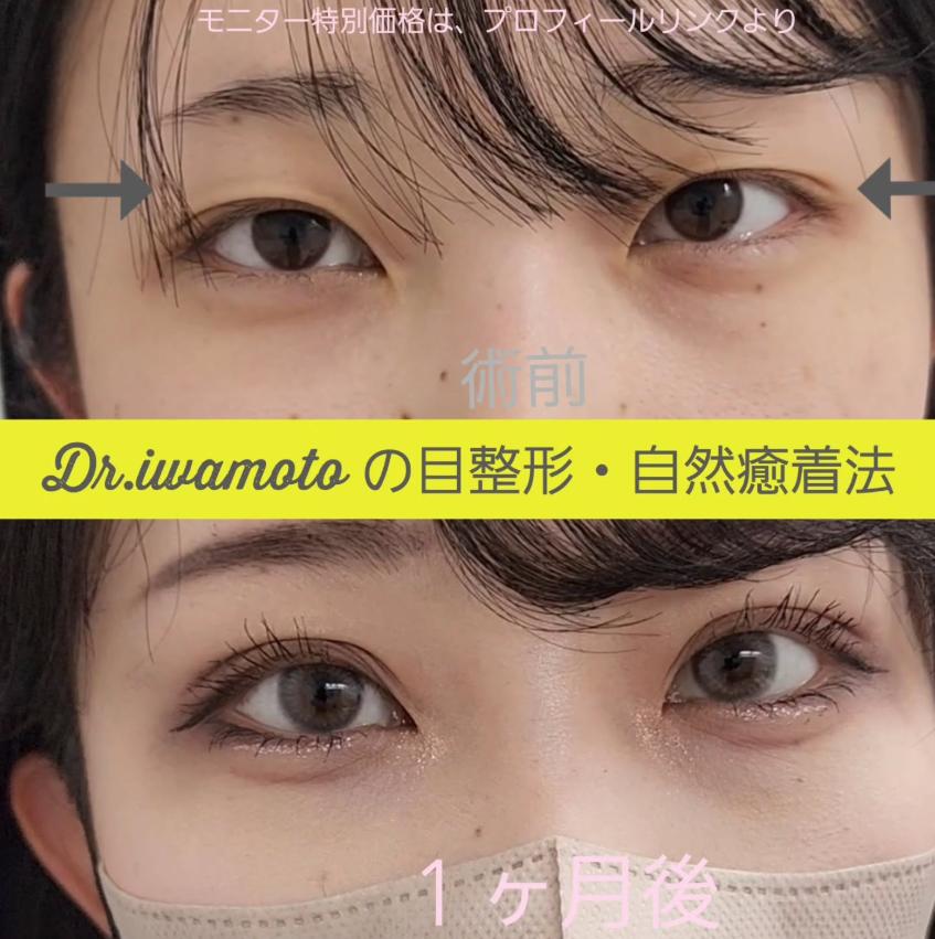 双眼皮手术