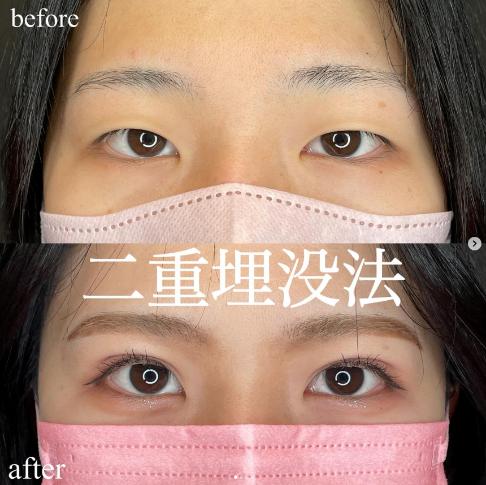 双眼皮手术