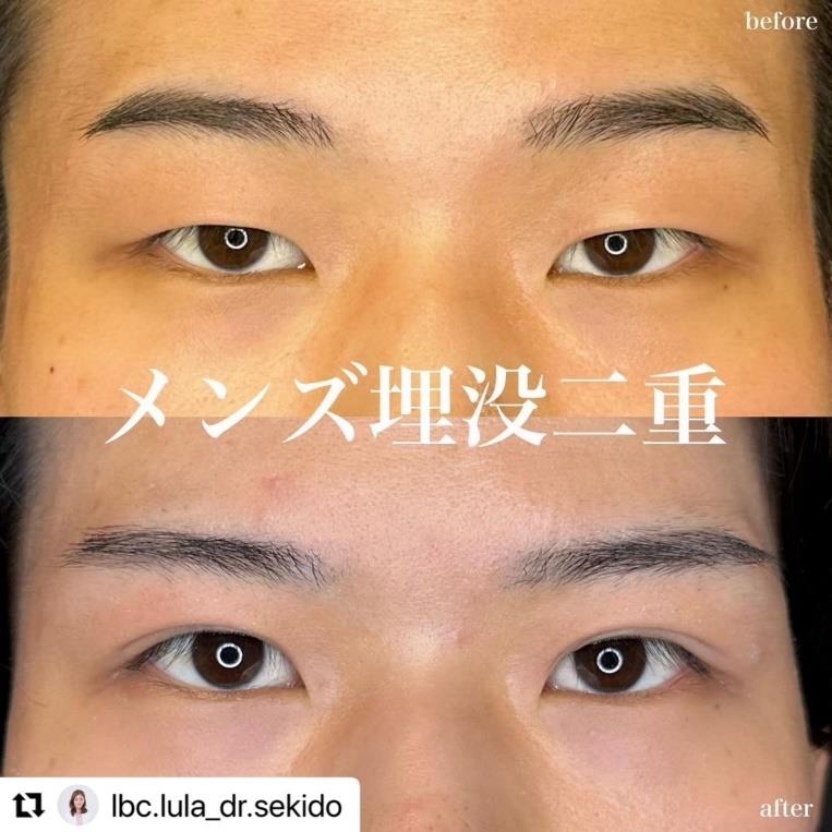 双眼皮手术
