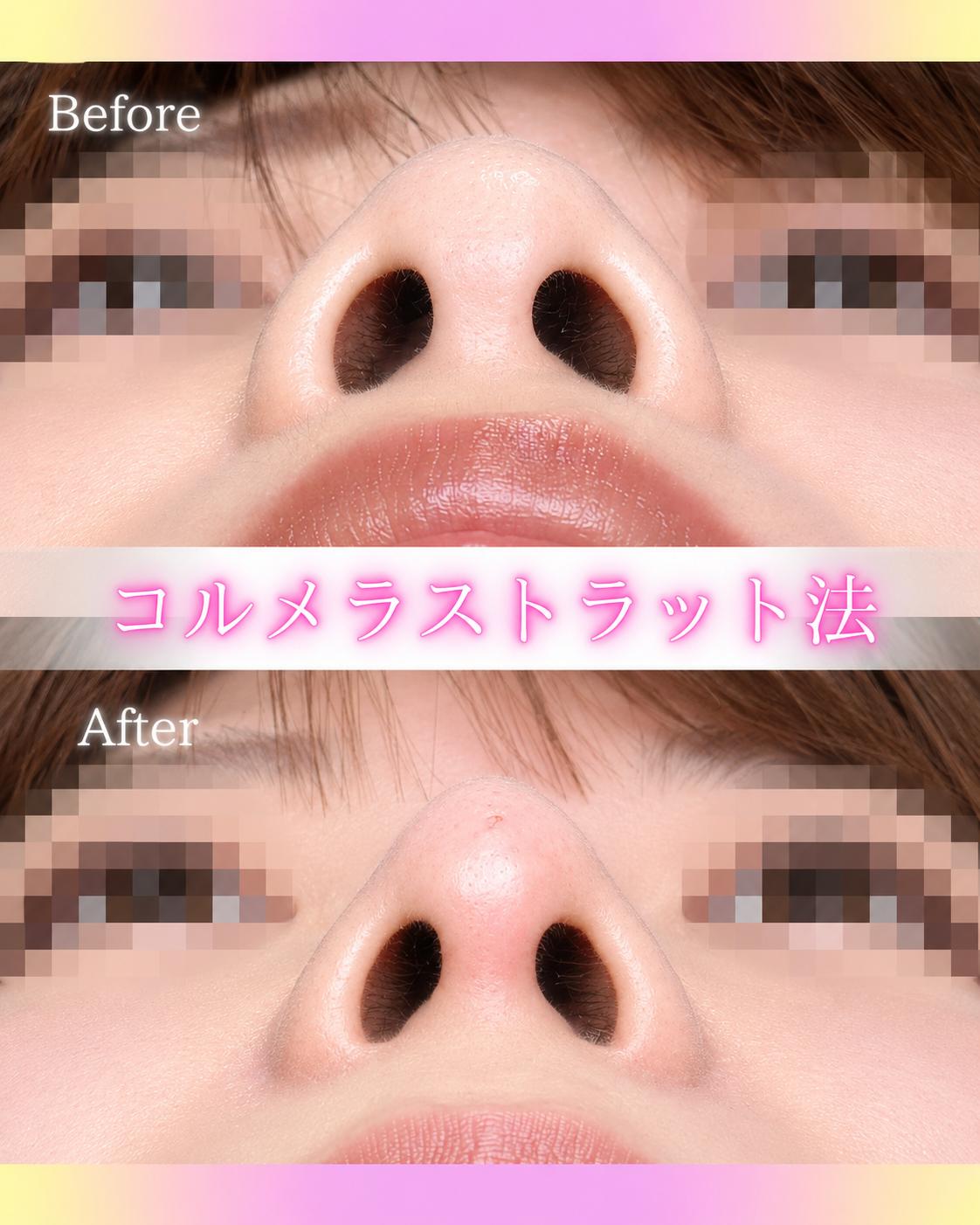玻尿酸填充