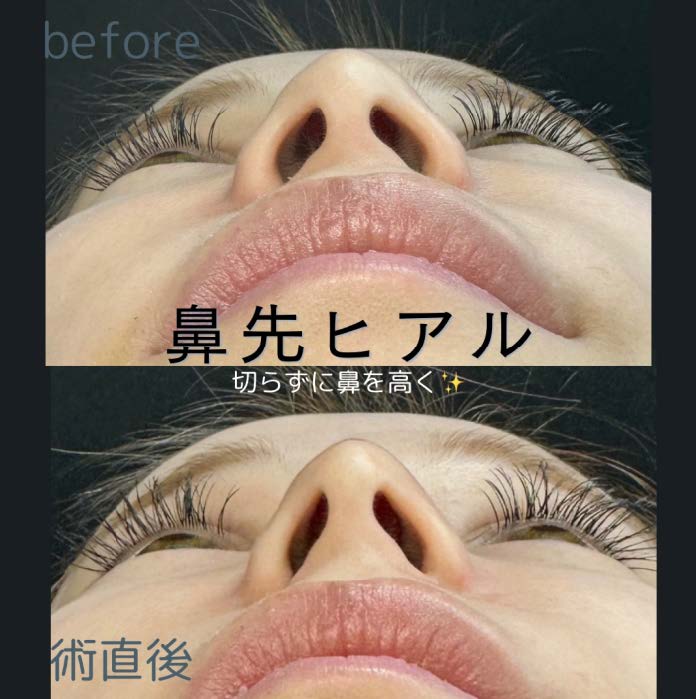 玻尿酸填充