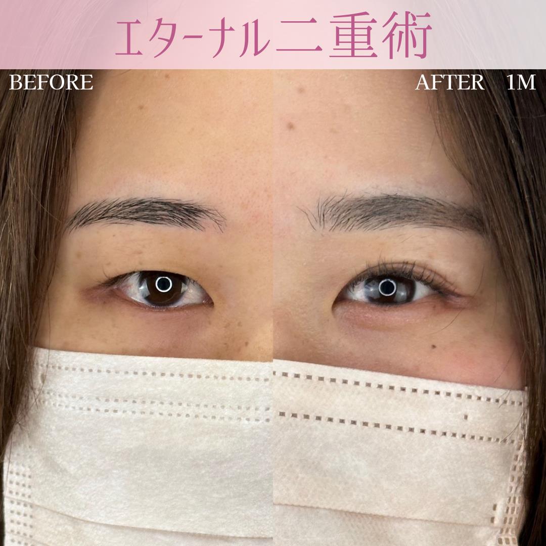 双眼皮手术