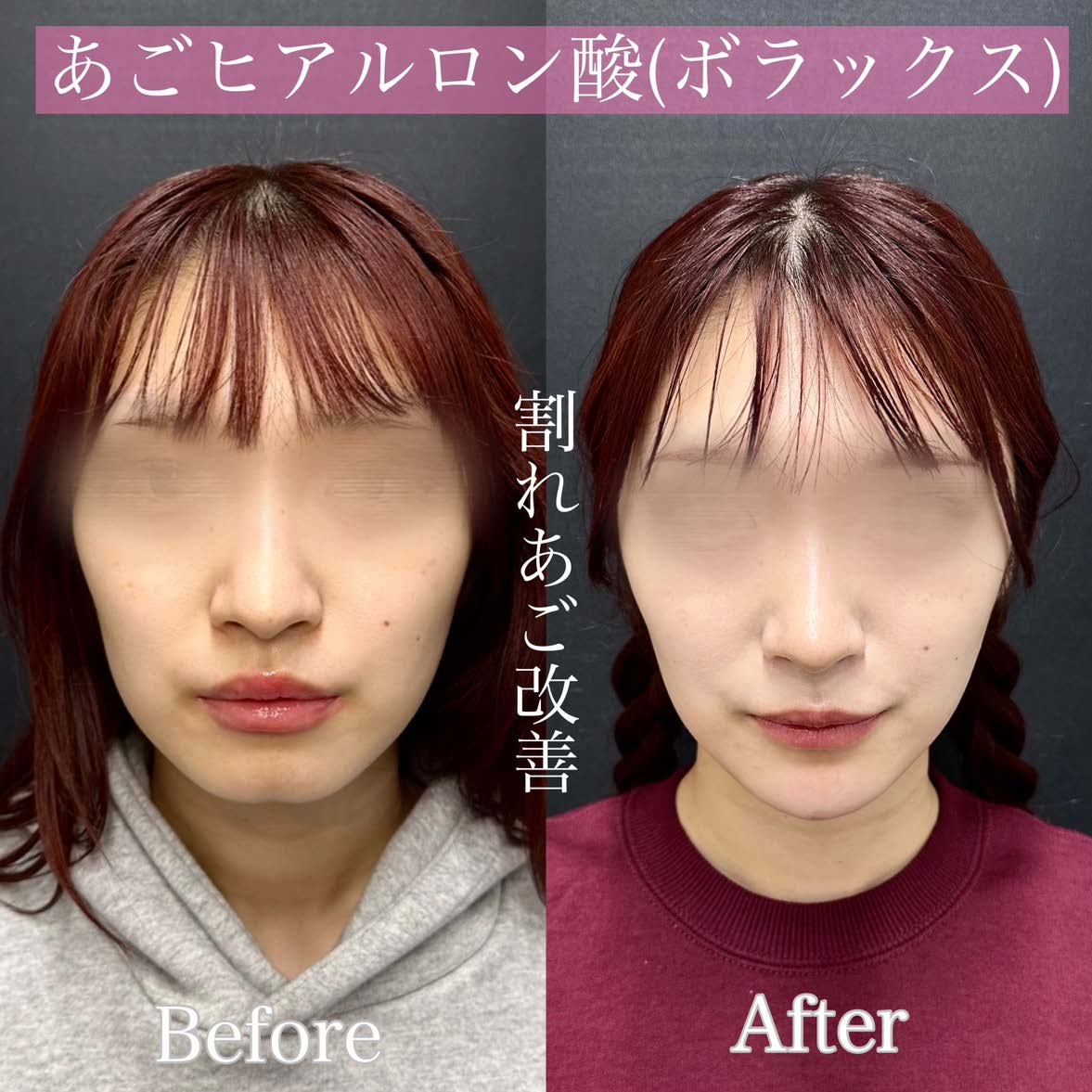 玻尿酸填充