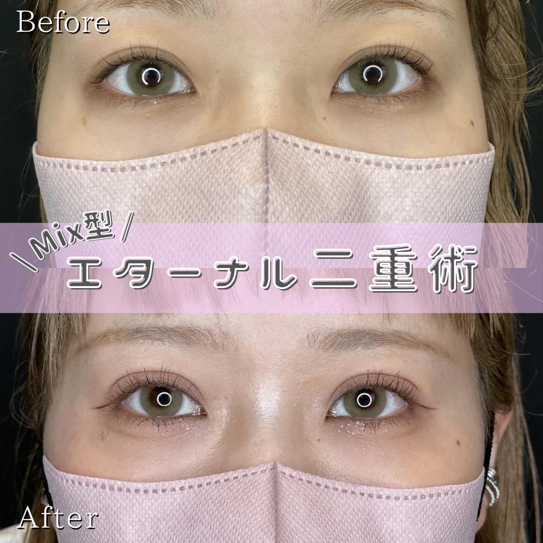 双眼皮手术