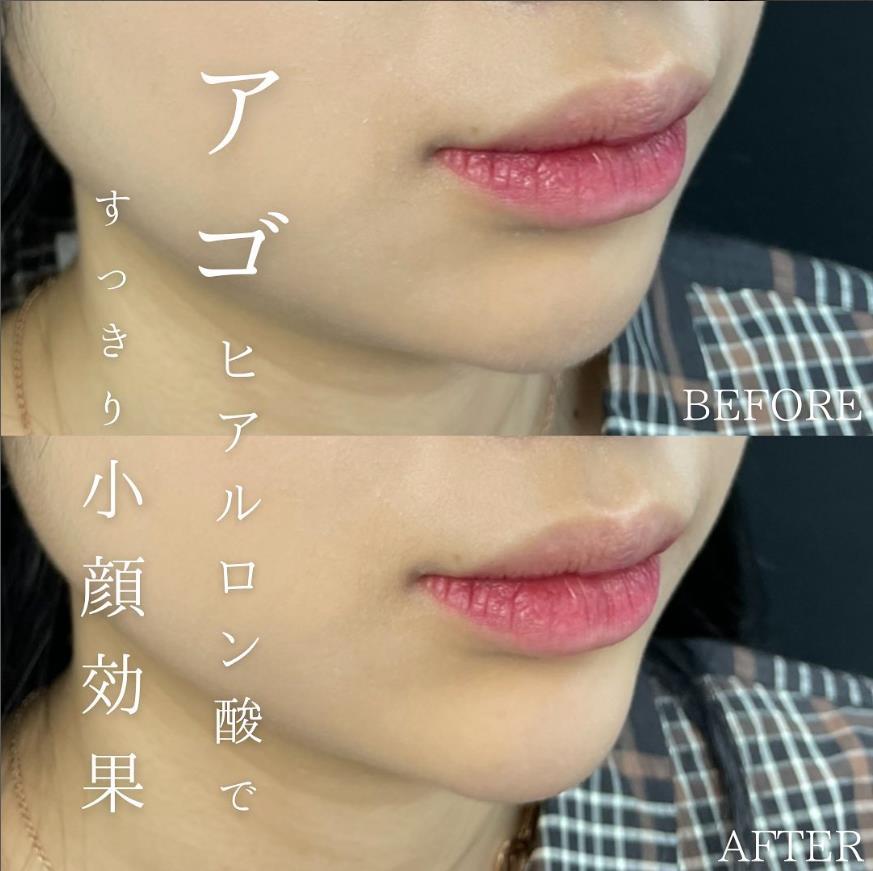 玻尿酸填充