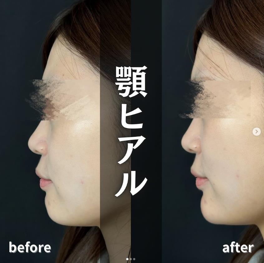 玻尿酸填充