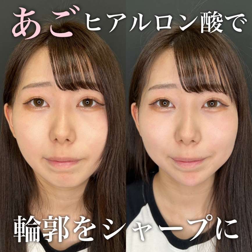 玻尿酸填充