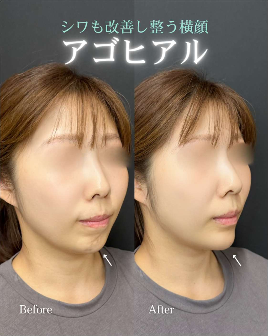 玻尿酸填充