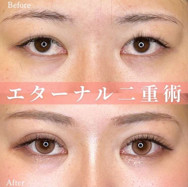 双眼皮手术