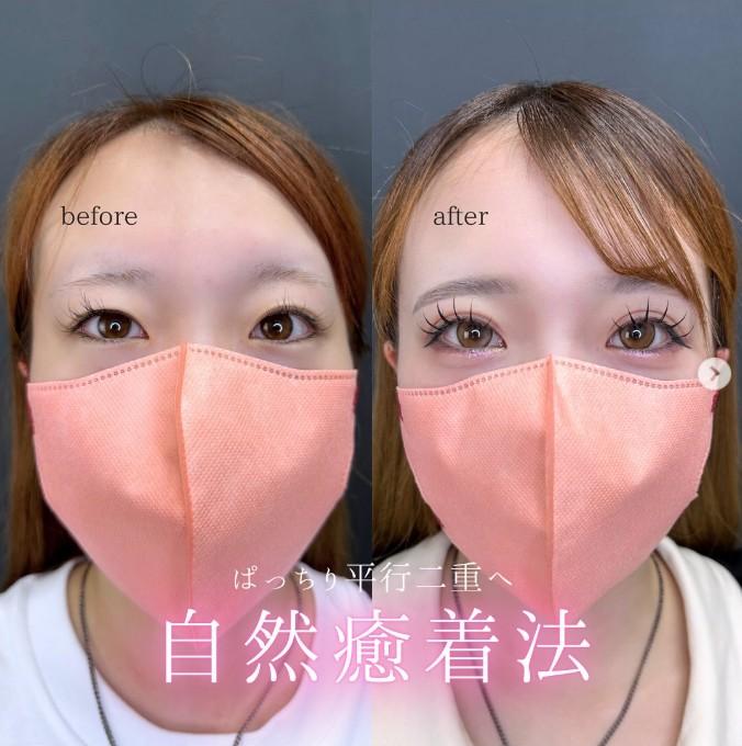 双眼皮手术