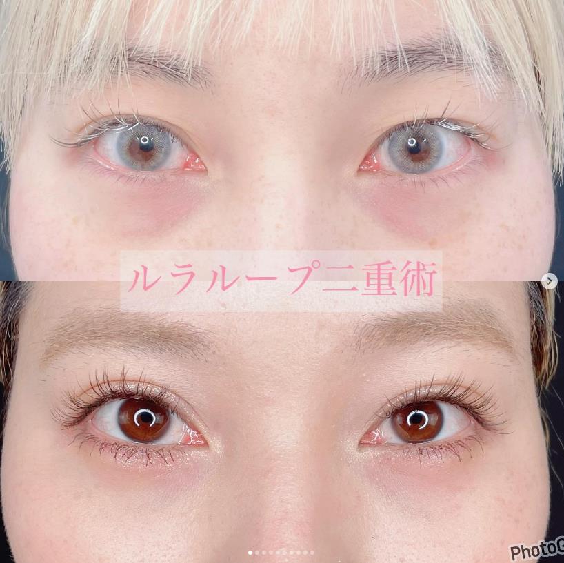 双眼皮手术