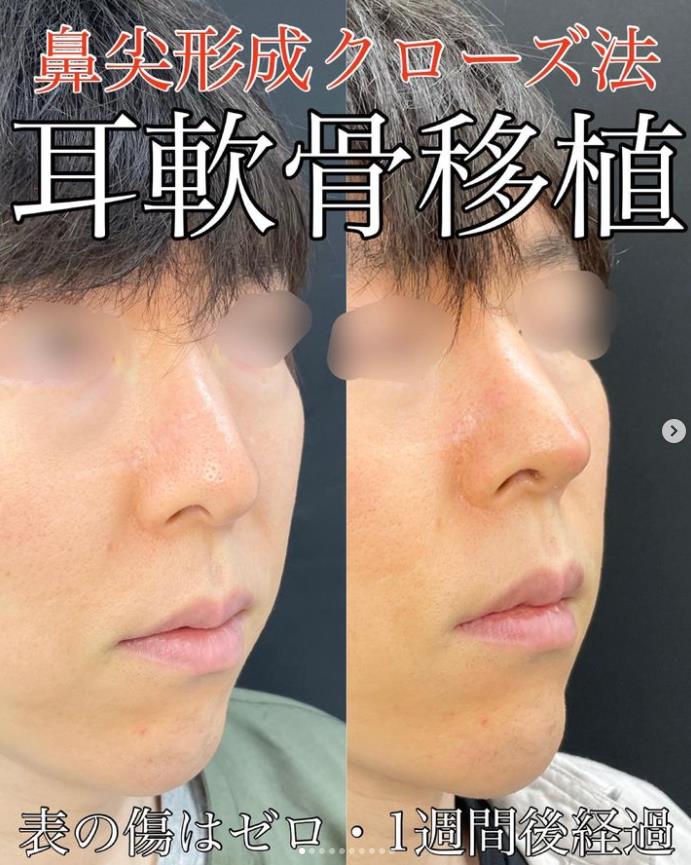 鼻综合整形 + 鼻尖整形 - 切开法