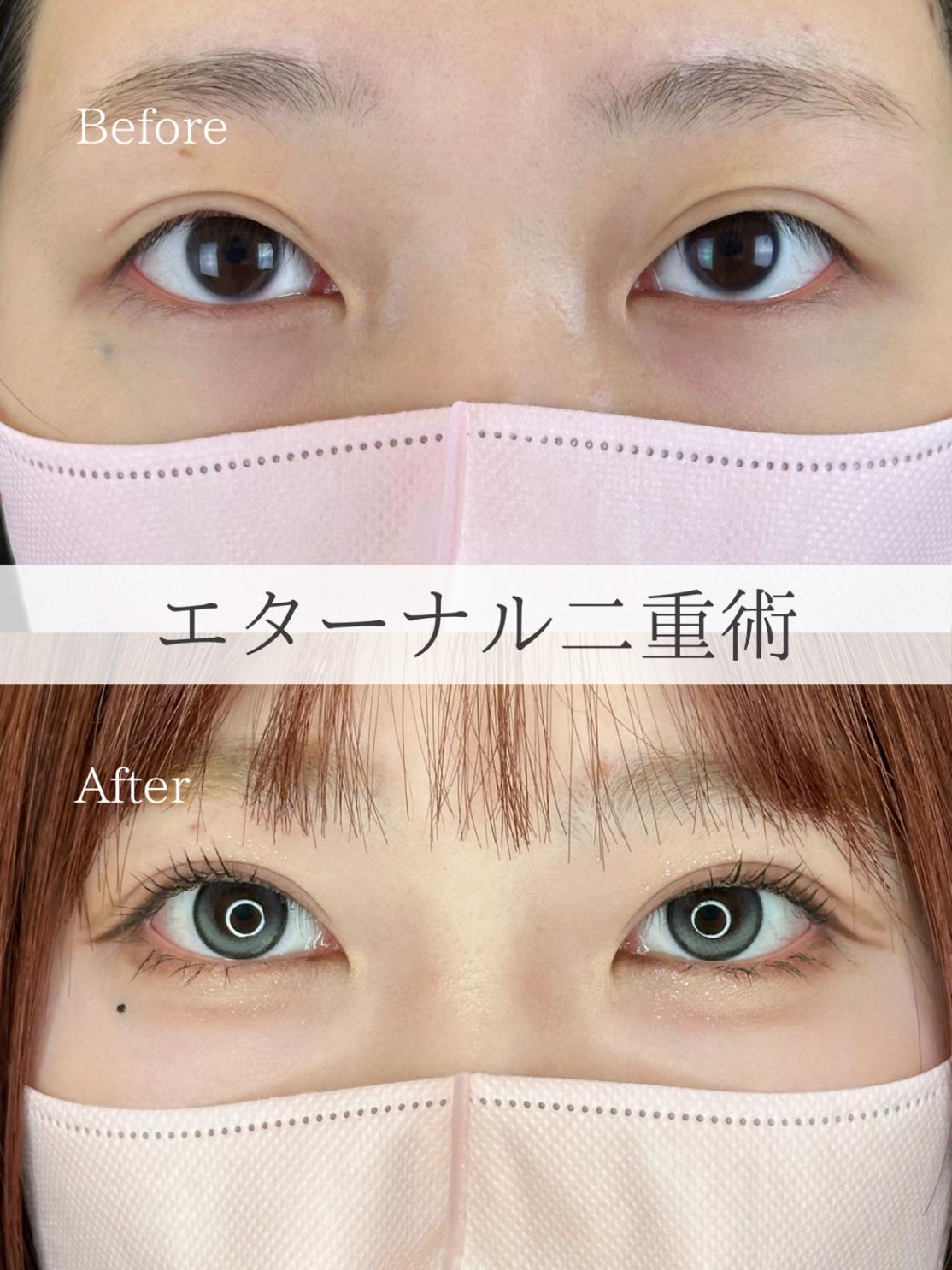 双眼皮手术