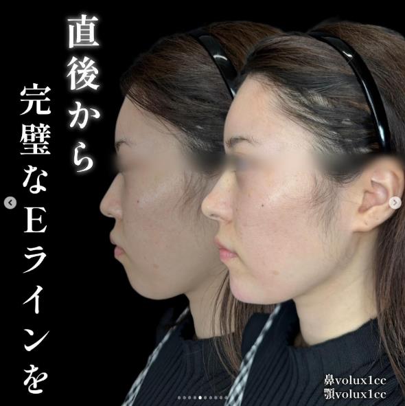 玻尿酸填充