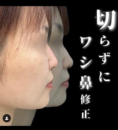 玻尿酸填充