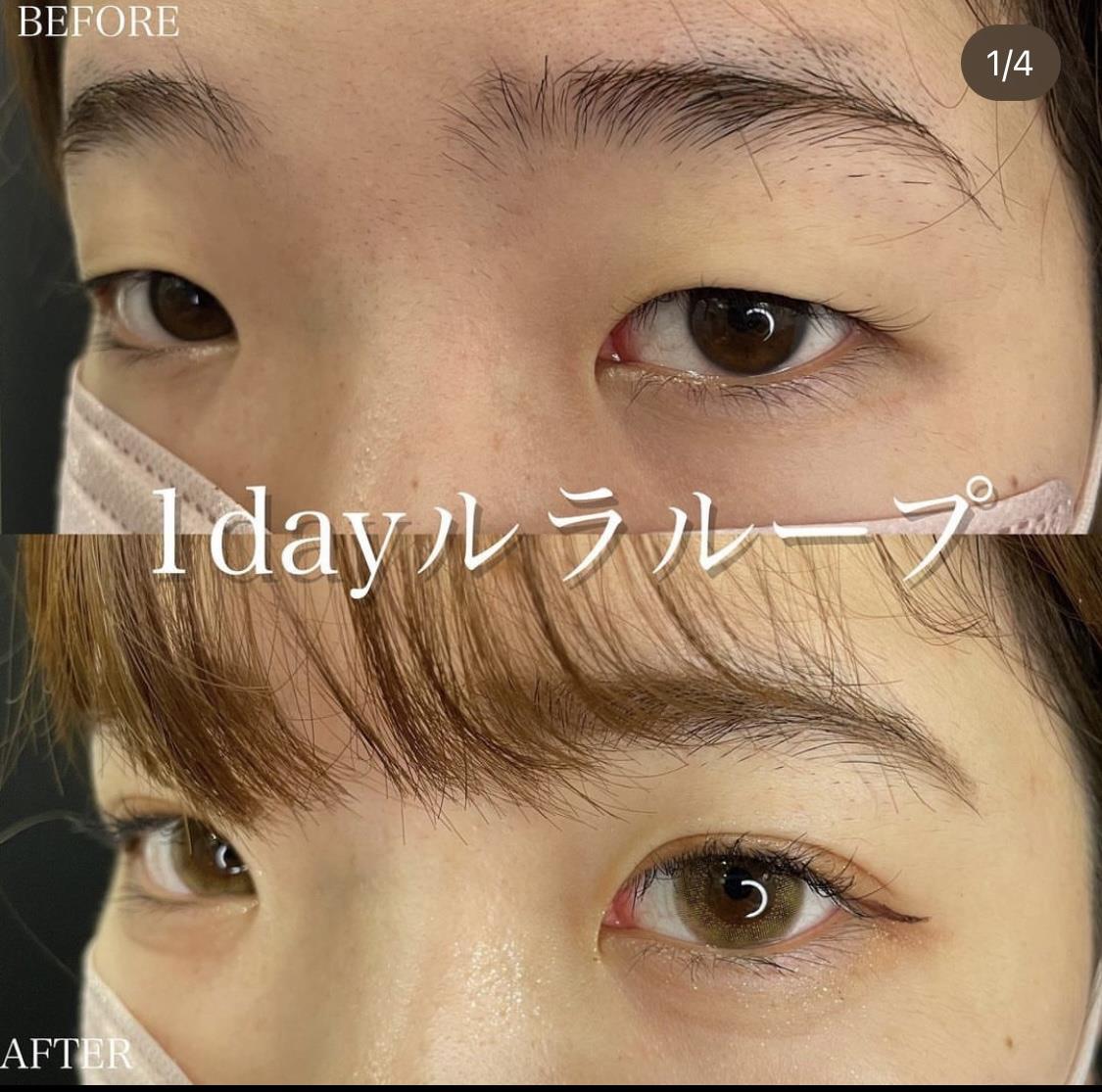 双眼皮手术