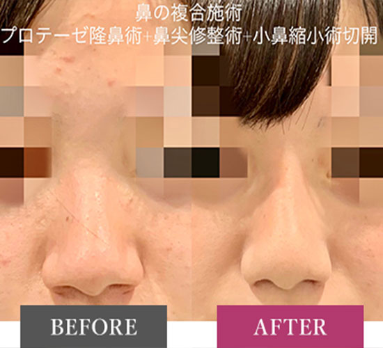 鼻综合整形 + 鼻梁整形 - 硅胶假体