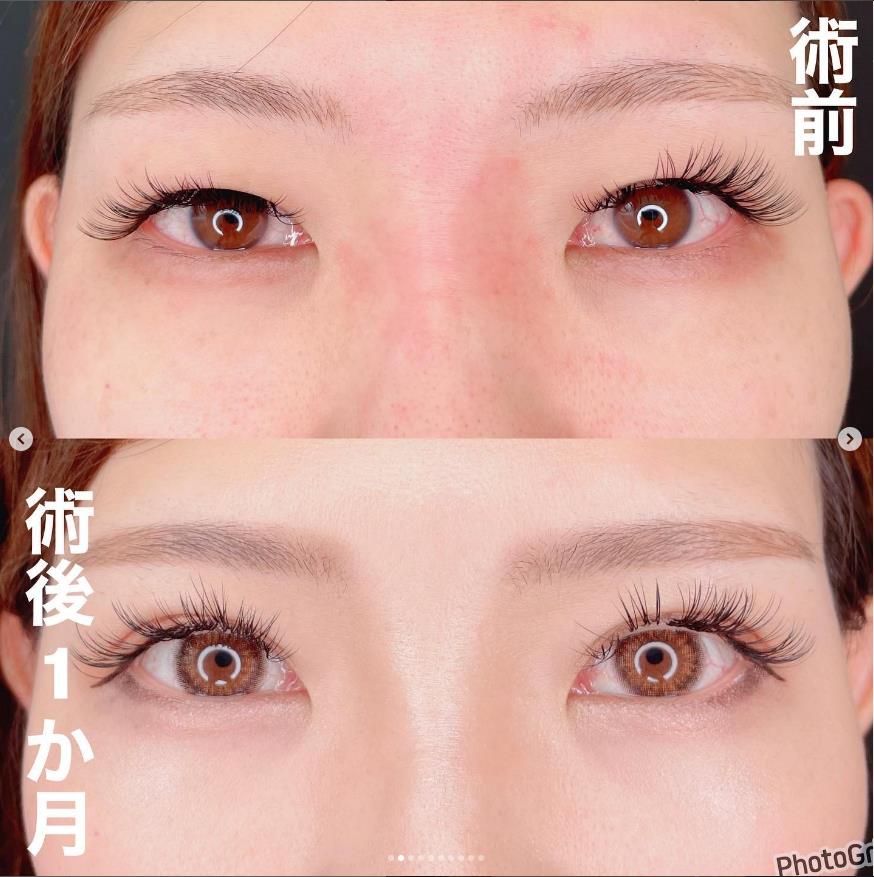 双眼皮手术
