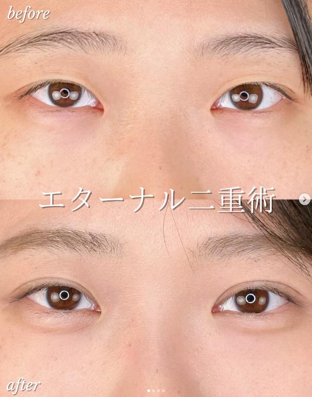 双眼皮手术
