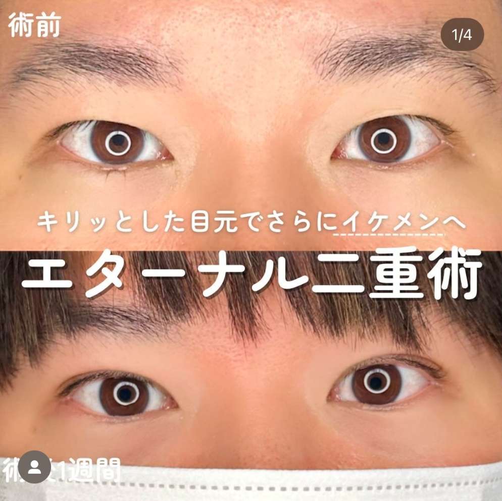 双眼皮手术