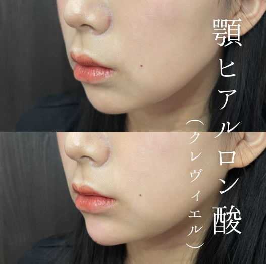 玻尿酸填充
