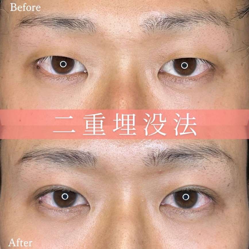 双眼皮手术
