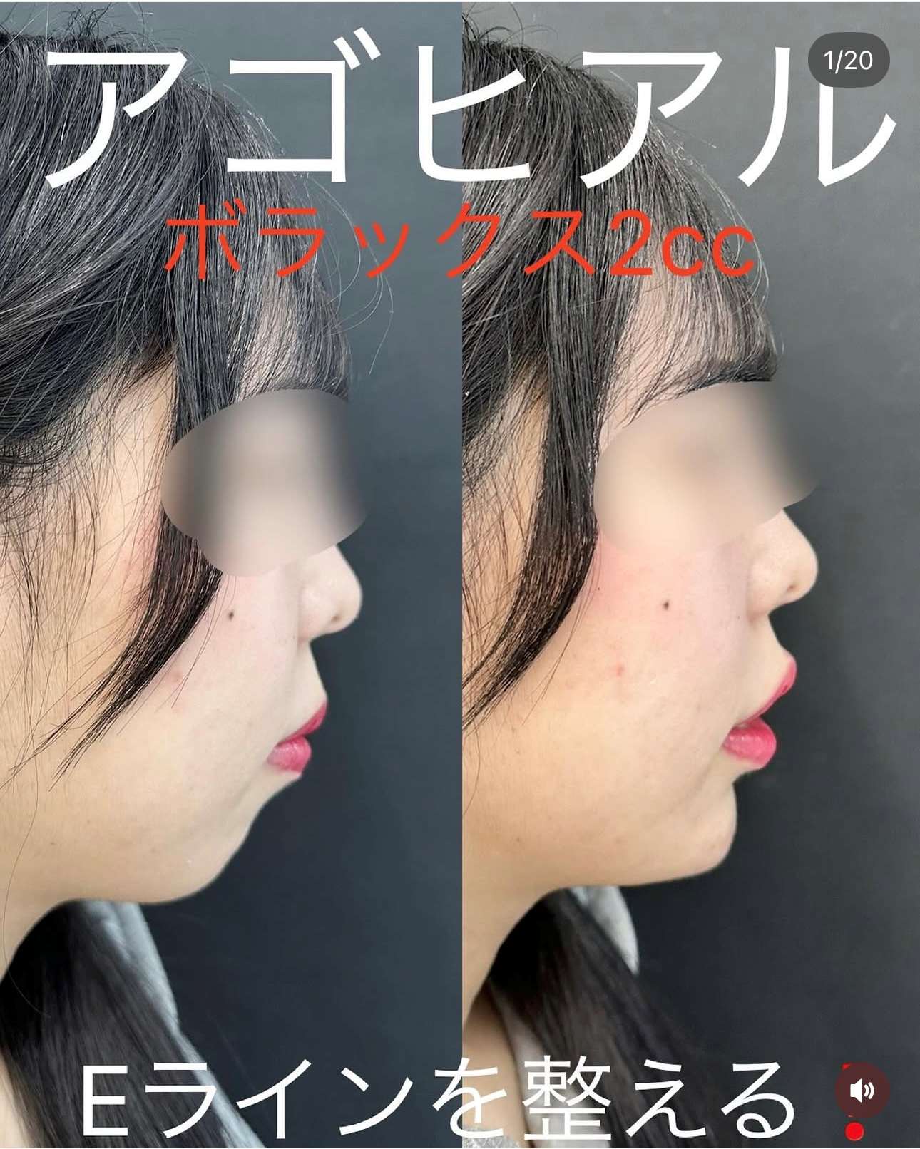 玻尿酸填充