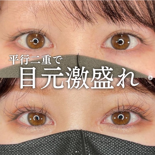 双眼皮手术
