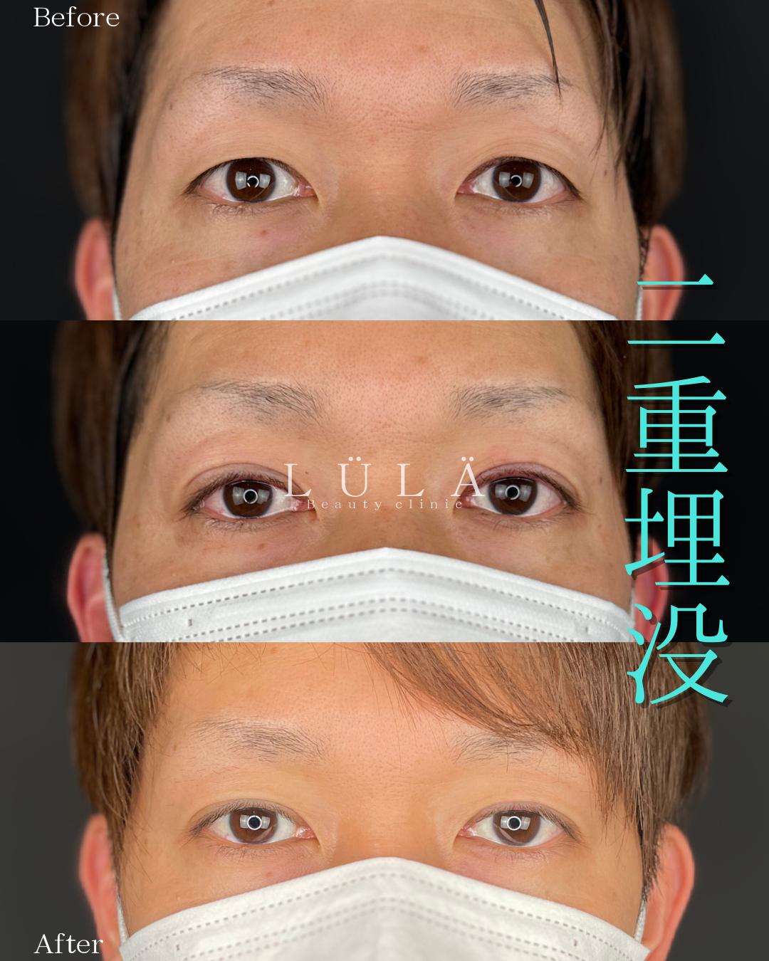 双眼皮手术