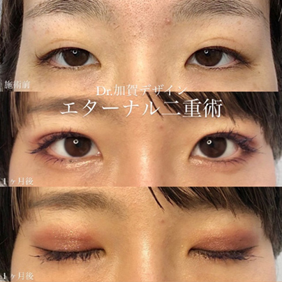双眼皮手术