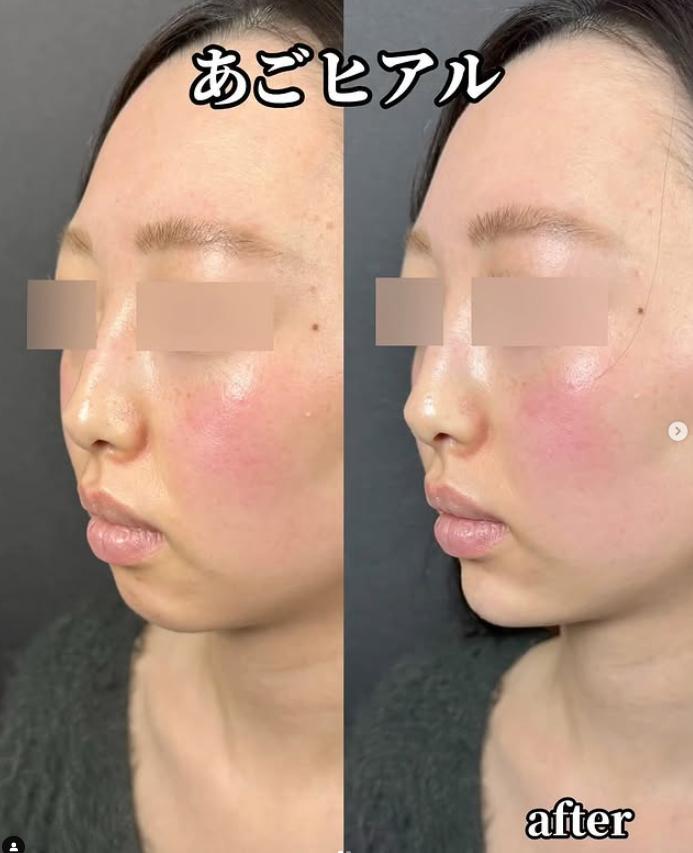玻尿酸填充
