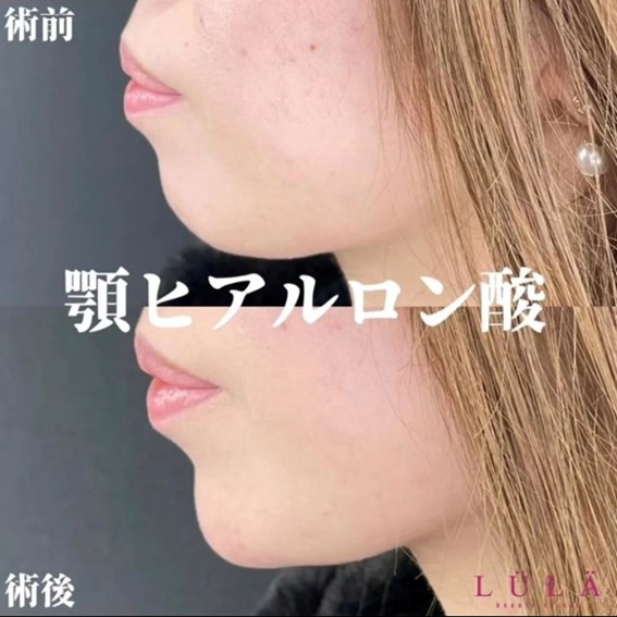 玻尿酸填充