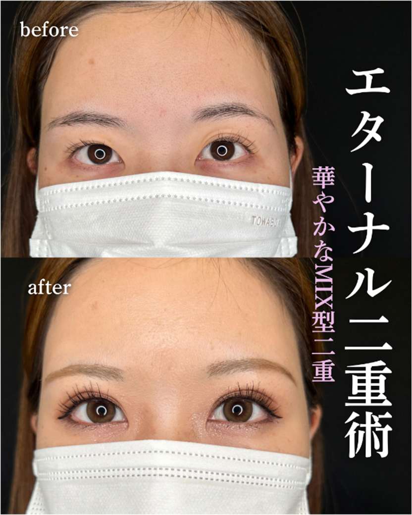 双眼皮手术