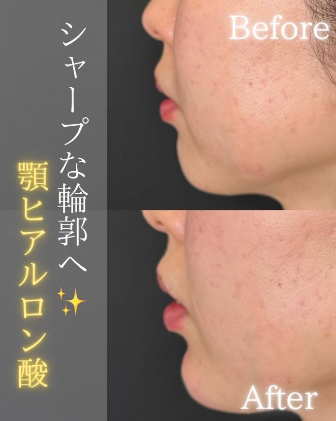 玻尿酸填充