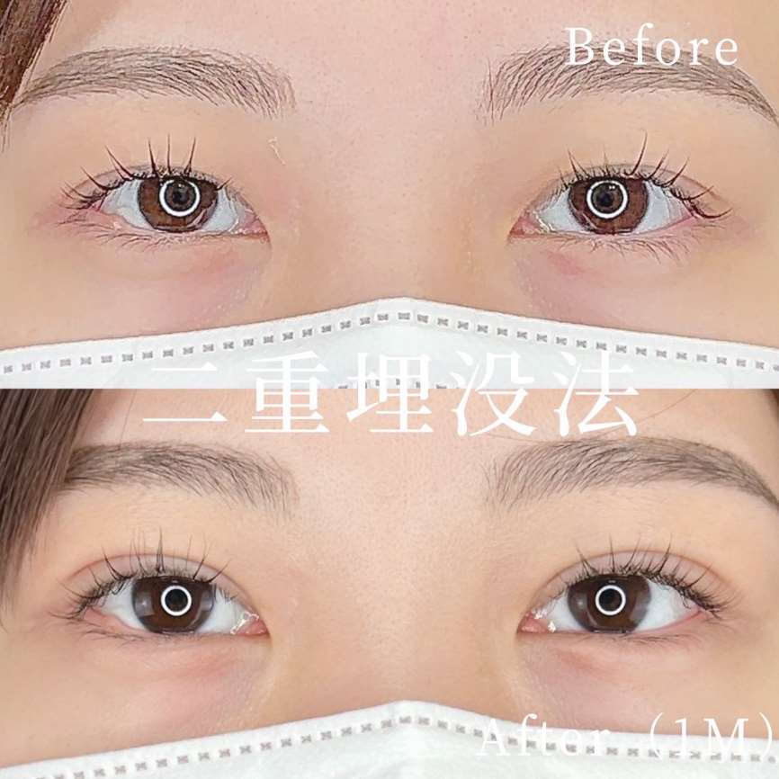 双眼皮手术