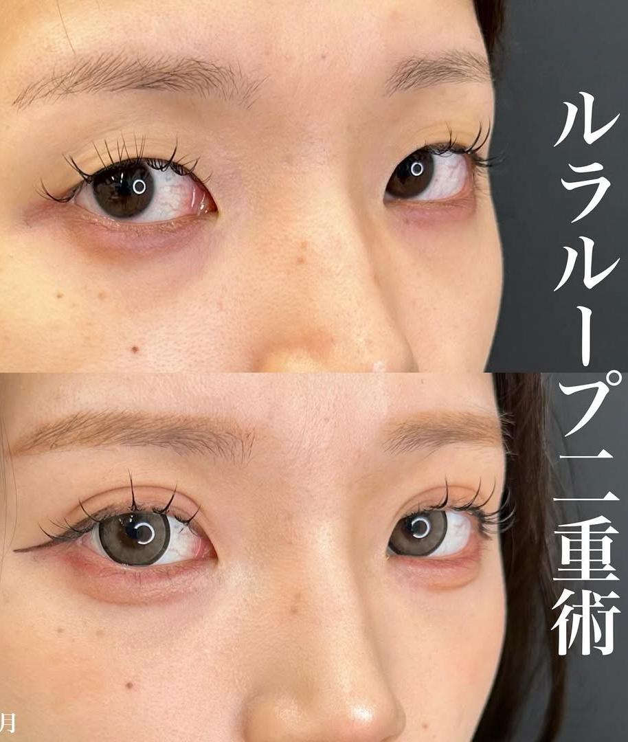 双眼皮手术