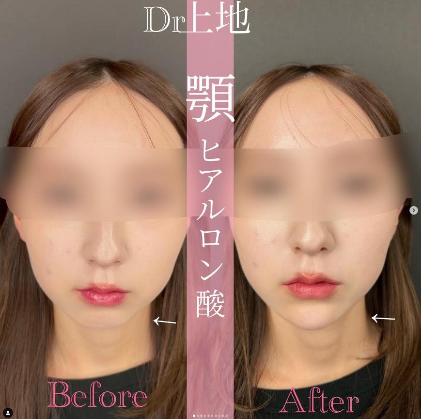 玻尿酸填充