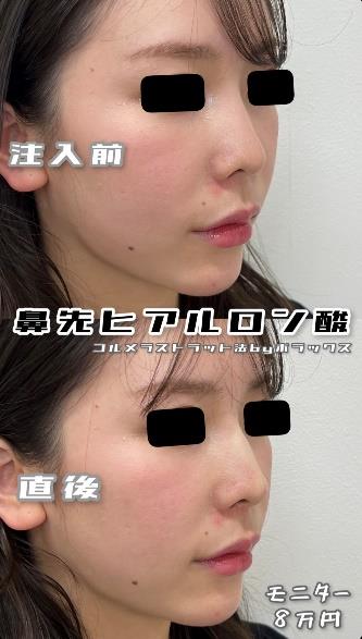 玻尿酸填充