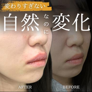 玻尿酸填充