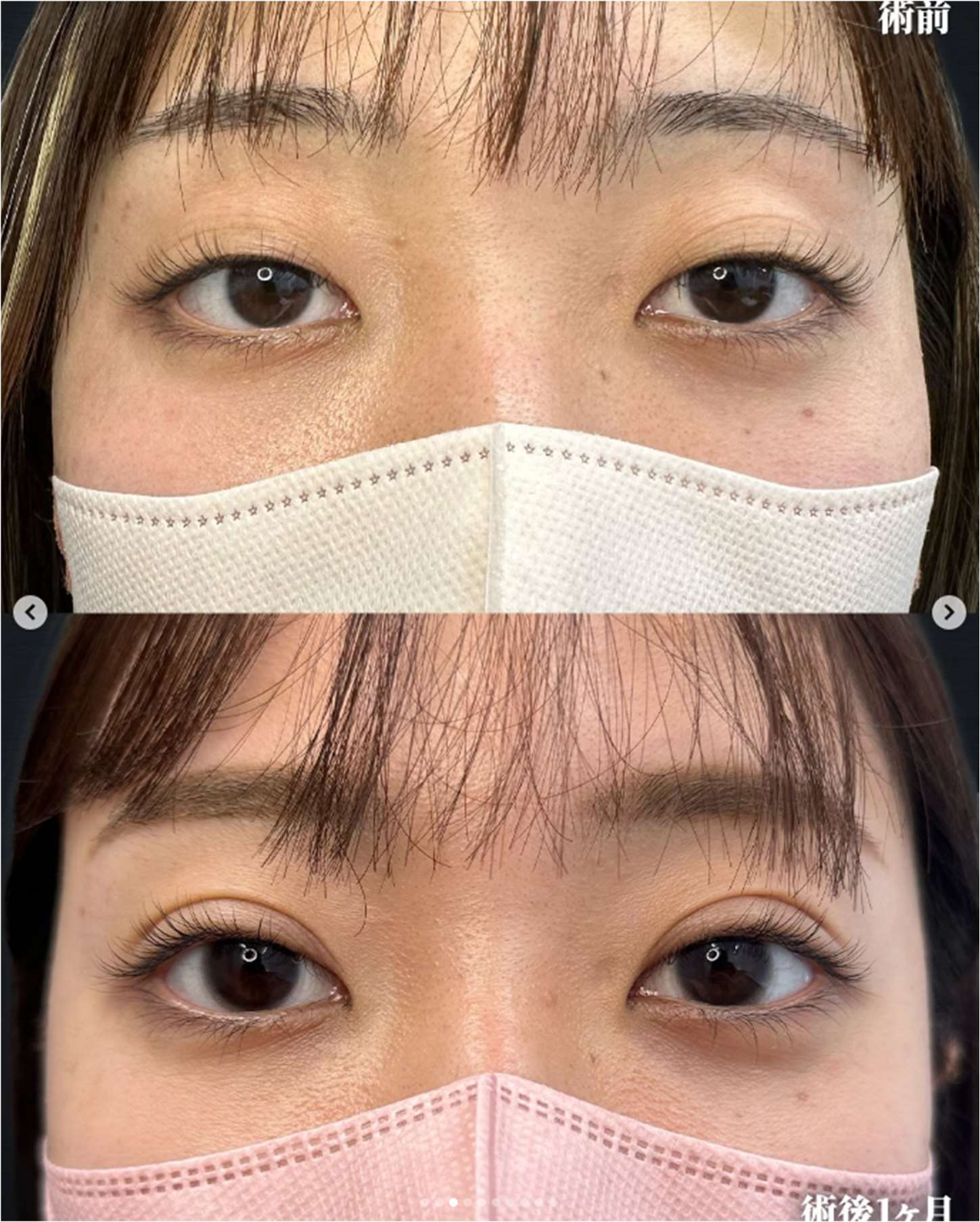 双眼皮手术
