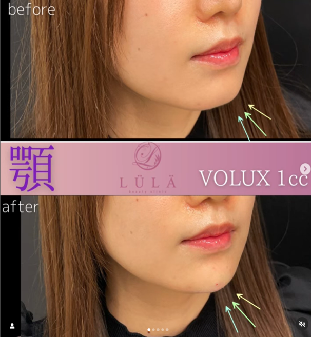 玻尿酸填充