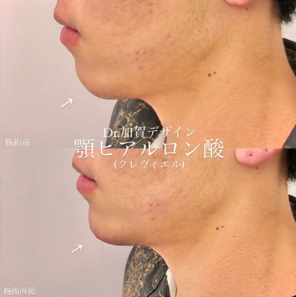 玻尿酸填充
