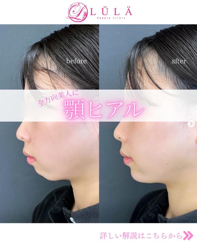 玻尿酸填充