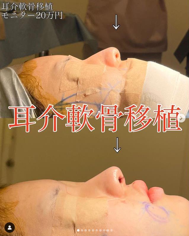 鼻综合整形 + 鼻尖整形 - 切开法