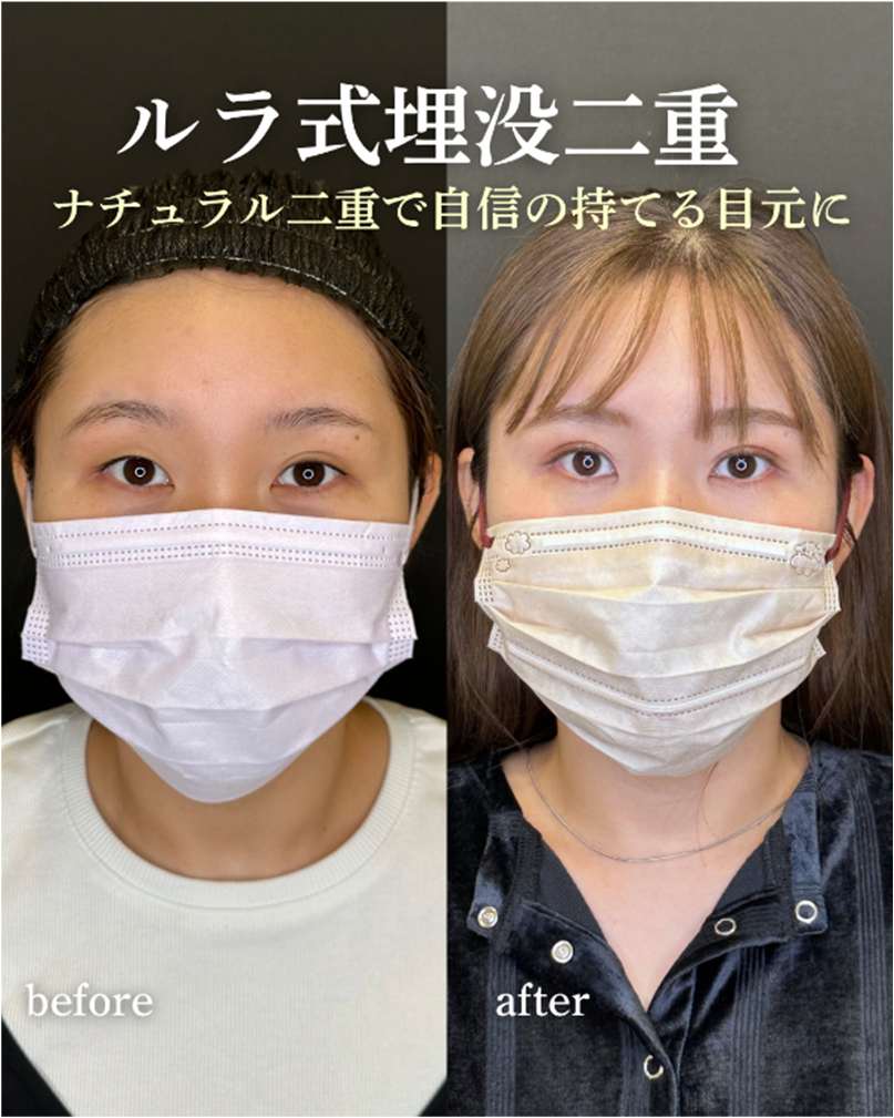 双眼皮手术