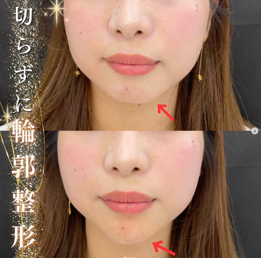 玻尿酸填充