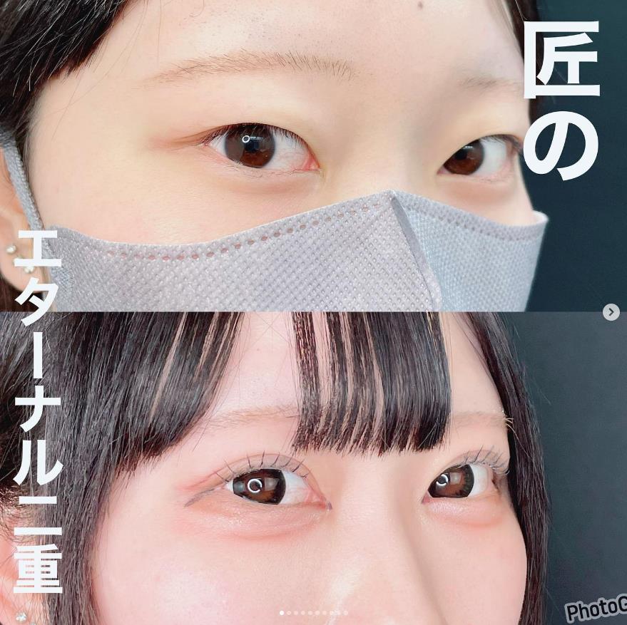 双眼皮手术