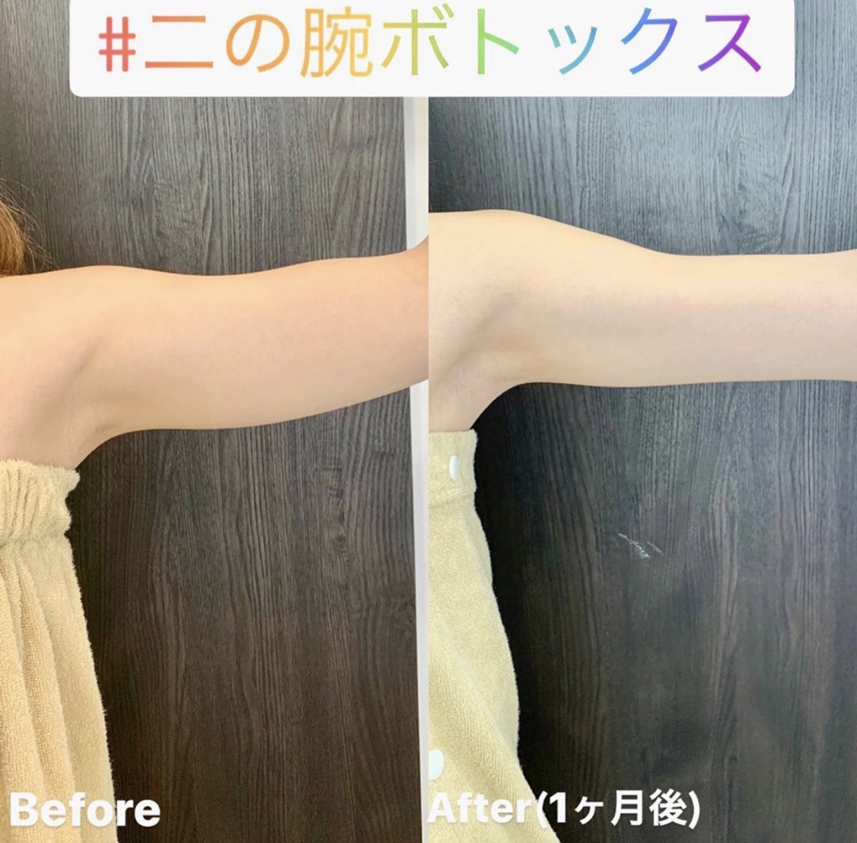 瘦肩针/瘦手臂针