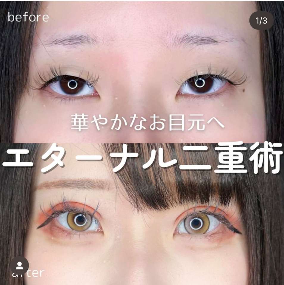 双眼皮手术